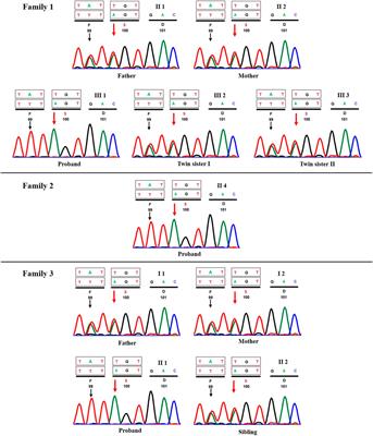 Case Report: Recurrent Variant c.298 TA in CCN6 Gene Found in Progressive Pseudorheumatoid Dysplasia Patients From Patni Community of Gujarat: A Report of Three Cases